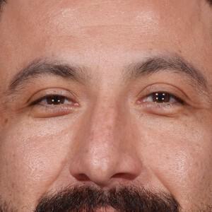 Liquid Rhinoplasty before at Dr. M.J. Trovato in Dallas, TX