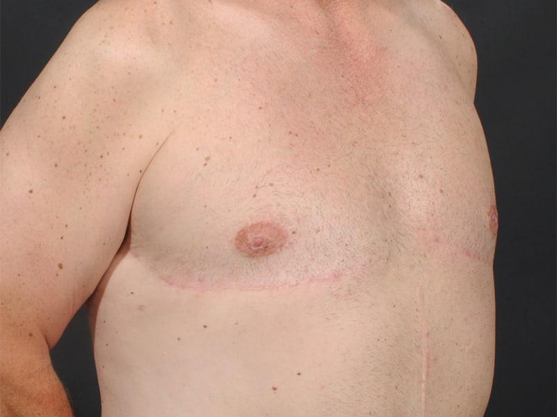 Dr. M.J. Trovato gynecomastia after — Dallas, TX