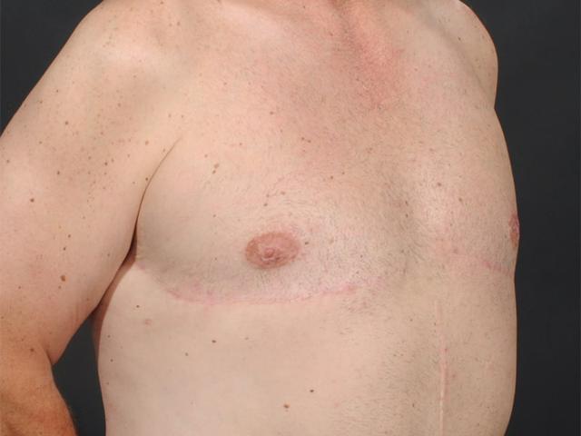 Gynecomastia Surgery after at Dr. M.J. Trovato in Dallas, TX