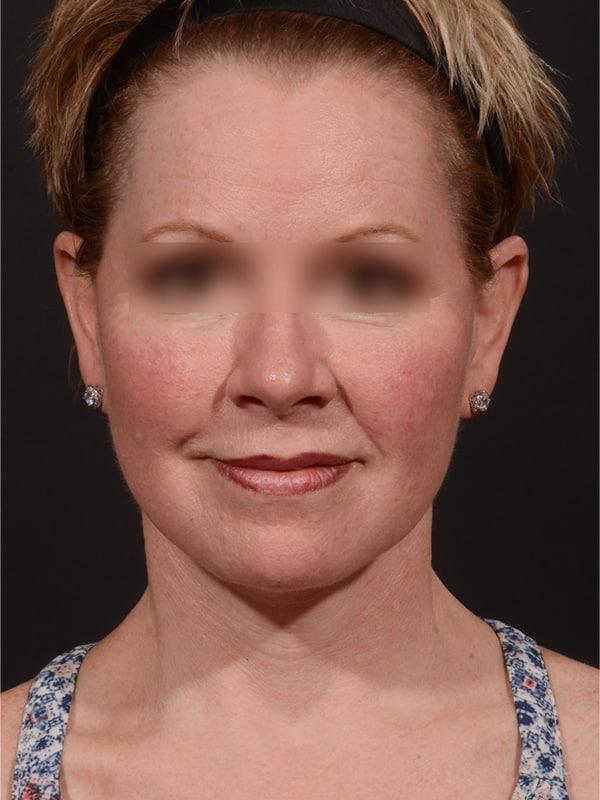 Dr. M.J. Trovato facelift after — Dallas, TX