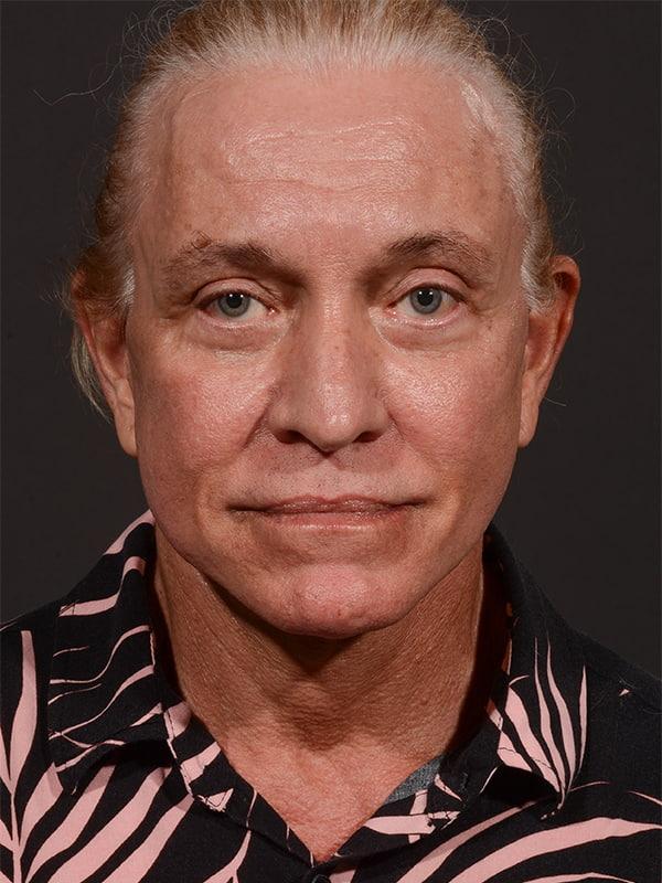 Dr. M.J. Trovato facelift after — Dallas, TX