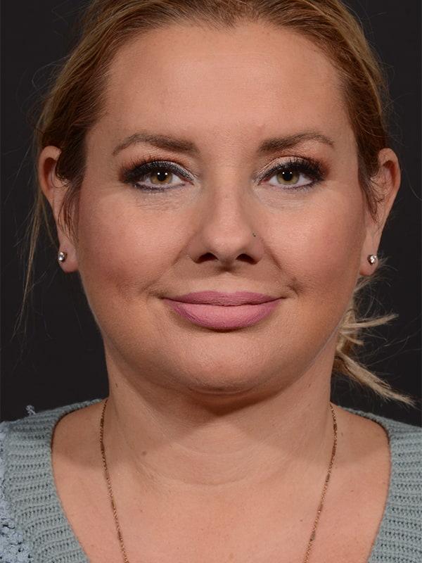 Dr. M.J. Trovato facelift after — Dallas, TX