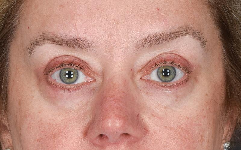 Dr. M.J. Trovato blepharoplasty after — Dallas, TX