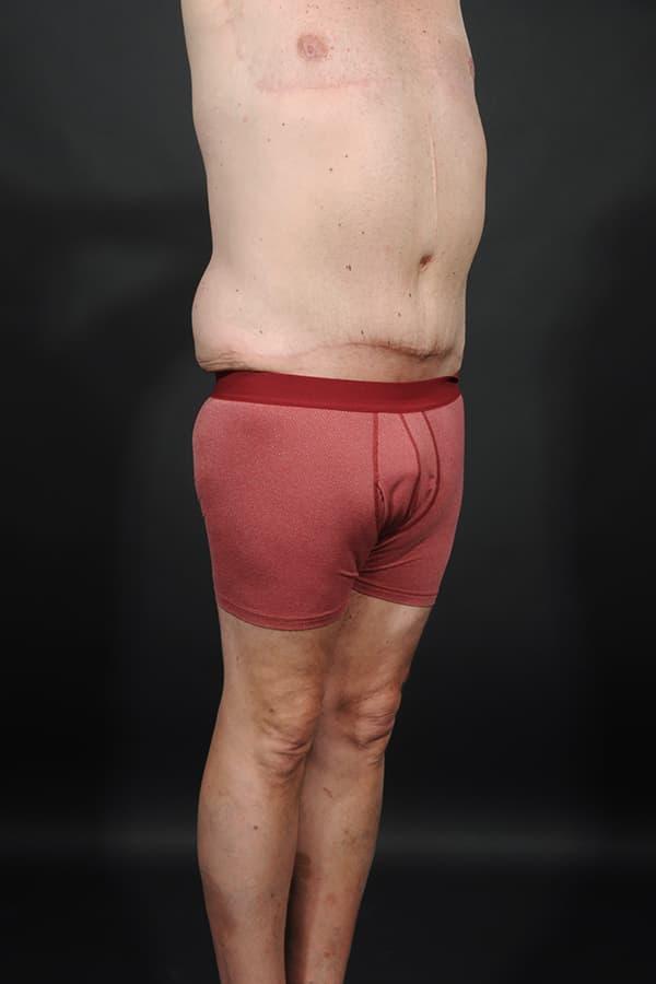 Dr. M.J. Trovato tummy tuck after — Dallas, TX