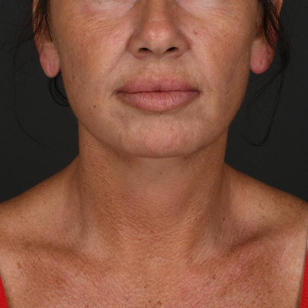 Neck Lift after at Dr. M.J. Trovato in Dallas, TX