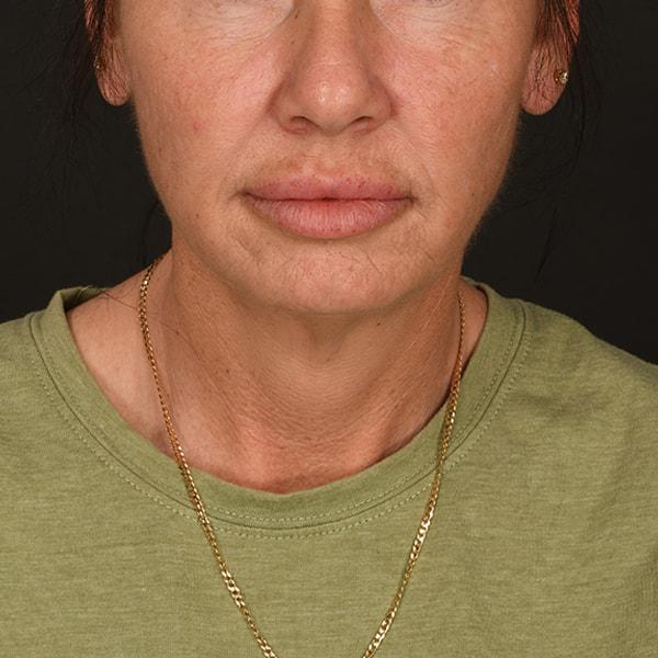 Neck Lift before at Dr. M.J. Trovato in Dallas, TX