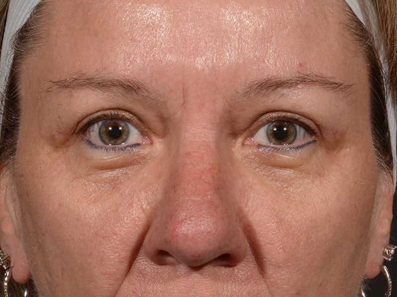 Dr. M.J. Trovato blepharoplasty after — Dallas, TX