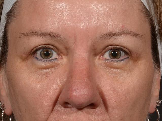 Blepharoplasty after at Dr. M.J. Trovato in Dallas, TX