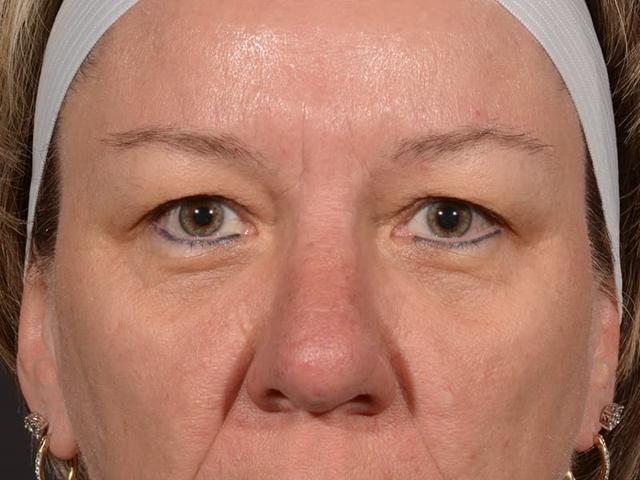 Blepharoplasty before at Dr. M.J. Trovato in Dallas, TX