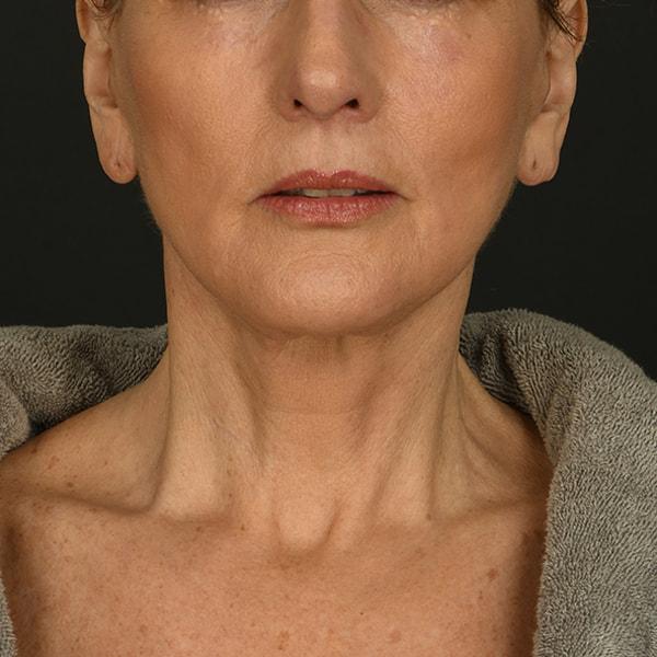 Neck Lift after at Dr. M.J. Trovato in Dallas, TX
