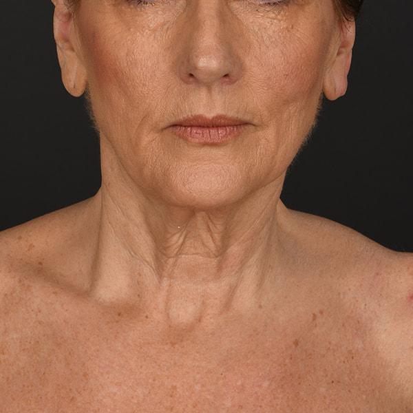 Neck Lift before at Dr. M.J. Trovato in Dallas, TX