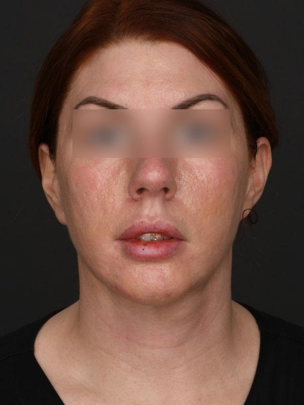 Chin Implant after at Dr. M.J. Trovato in Dallas, TX