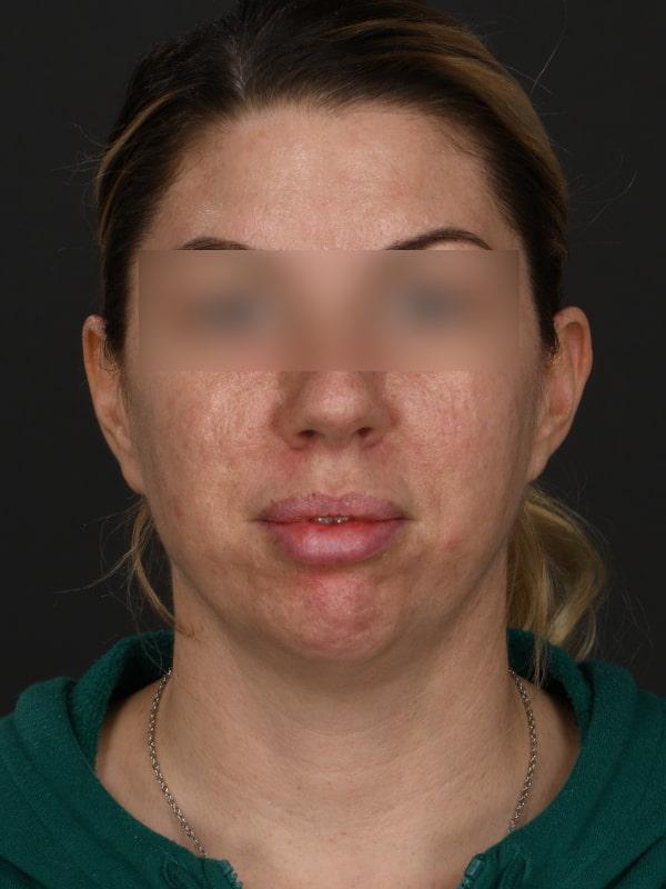 Chin Implant before at Dr. M.J. Trovato in Dallas, TX