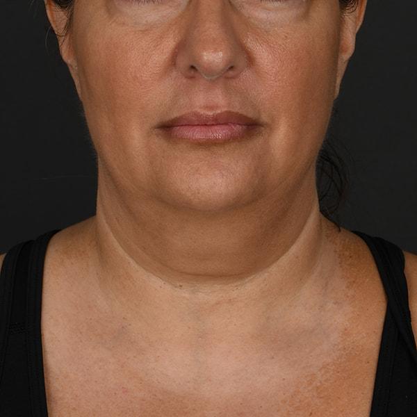 Neck Lift before at Dr. M.J. Trovato in Dallas, TX