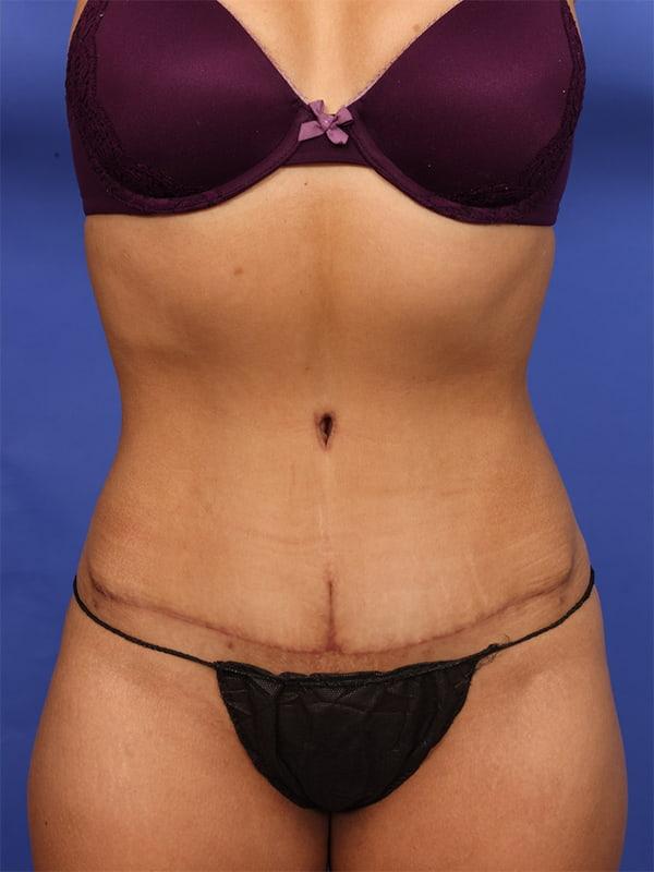 Dr. M.J. Trovato tummy tuck after — Dallas, TX