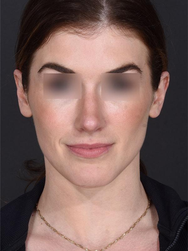 Dr. M.J. Trovato rhinoplasty after — Dallas, TX