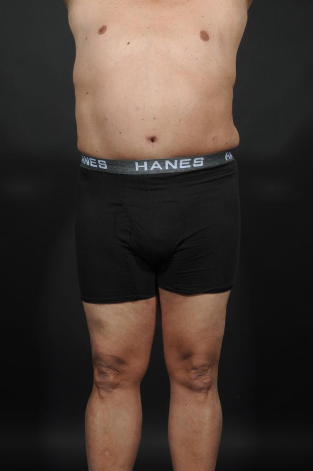 Tummy Tuck after at Dr. M.J. Trovato in Dallas, TX