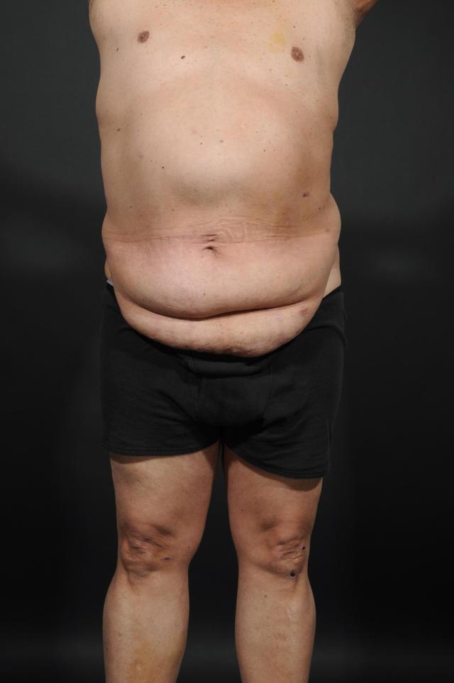 Tummy Tuck before at Dr. M.J. Trovato in Dallas, TX