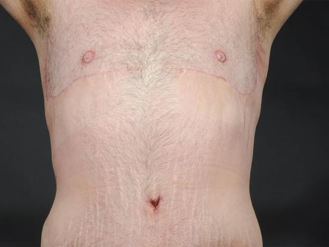 Gynecomastia Surgery after at Dr. M.J. Trovato in Dallas, TX