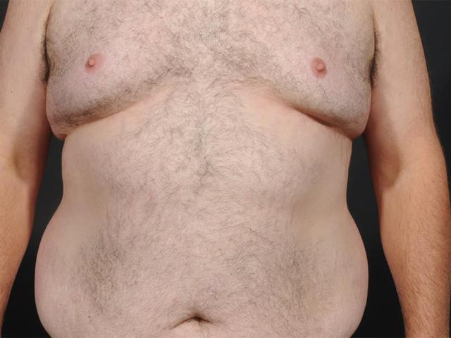 Gynecomastia Surgery before at Dr. M.J. Trovato in Dallas, TX
