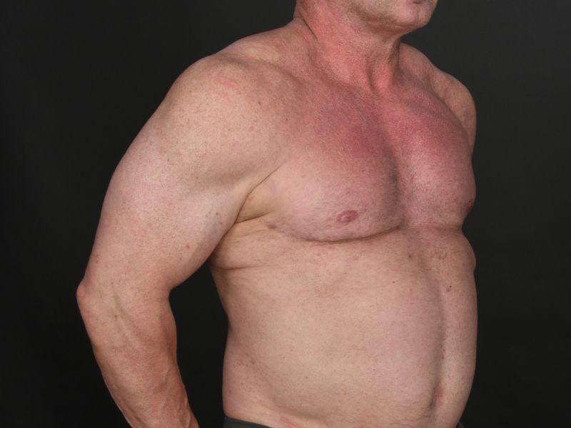Dr. M.J. Trovato body contouring after — Dallas, TX