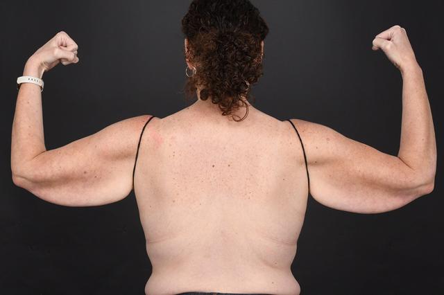 Arm Lift before at Dr. M.J. Trovato in Dallas, TX