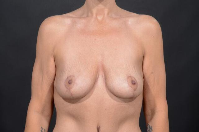 Breast Lift after at Dr. M.J. Trovato in Dallas, TX