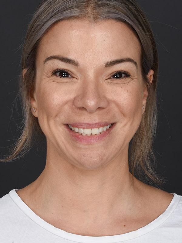 Dr. M.J. Trovato rhinoplasty after — Dallas, TX
