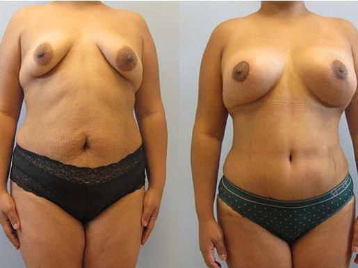 Temmen Plastic Surgery (Traci Temmen, MD) mommy makeover result — Tampa, FL