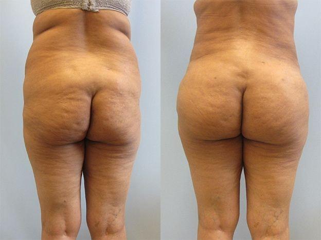Temmen Plastic Surgery (Traci Temmen, MD) bbl result — Tampa, FL