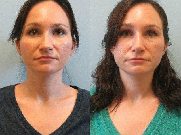 Rhinoplasty result at Temmen Plastic Surgery (Traci Temmen, MD) in Tampa, FL