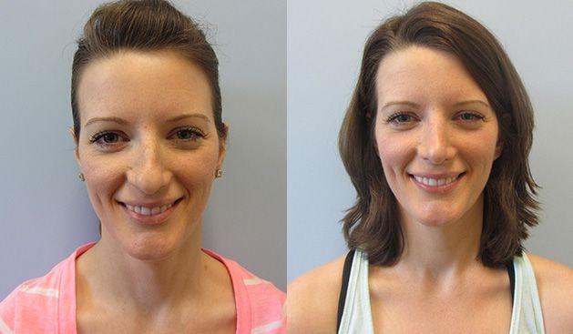 Rhinoplasty result at Temmen Plastic Surgery (Traci Temmen, MD) in Tampa, FL