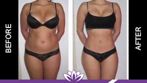 Laser Duet Med Spa – Botox, Dermal Fillers, Body Contouring & Tattoo Removal in Dearborn MI laser treatment result — Dearborn, MI