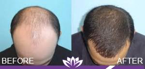 Laser Duet Med Spa – Botox, Dermal Fillers, Body Contouring & Tattoo Removal in Dearborn MI laser treatment result — Dearborn, MI