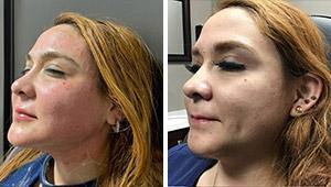 Laser Duet Med Spa – Botox, Dermal Fillers, Body Contouring & Tattoo Removal in Dearborn MI laser treatment result — Dearborn, MI