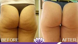 Laser Duet Med Spa – Botox, Dermal Fillers, Body Contouring & Tattoo Removal in Dearborn MI laser treatment result — Dearborn, MI