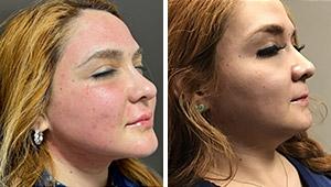 Laser Skin Resurfacing result at Laser Duet Med Spa – Botox, Dermal Fillers, Body Contouring & Tattoo Removal in Dearborn MI in Dearborn, MI