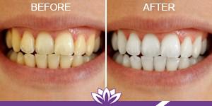 Laser Duet Med Spa – Botox, Dermal Fillers, Body Contouring & Tattoo Removal in Dearborn MI laser treatment result — Dearborn, MI