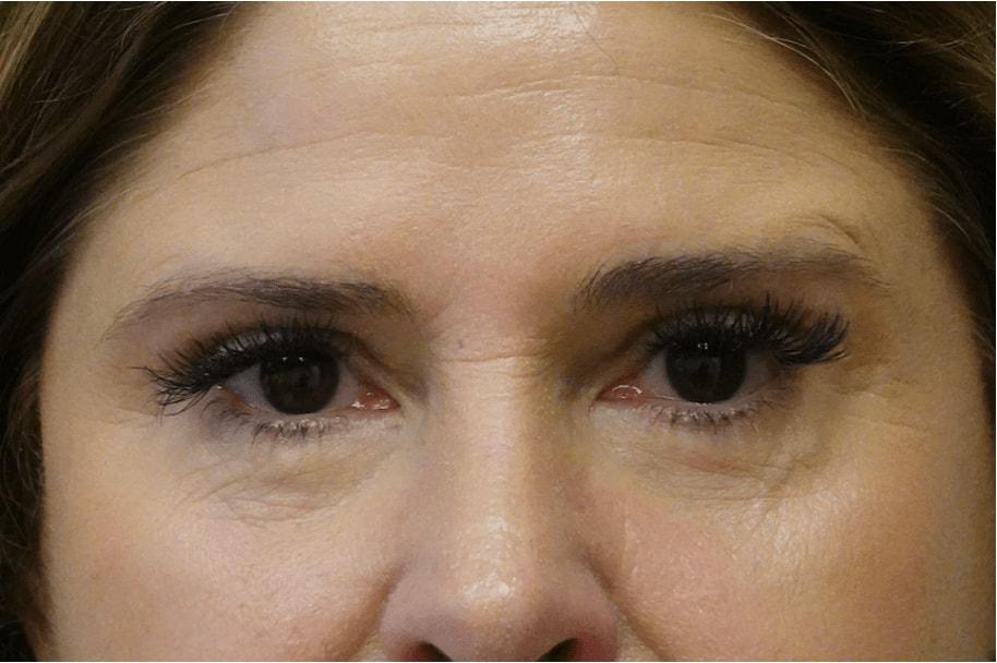 Jason Clain, MD eyelid lift after — Harrison, NY