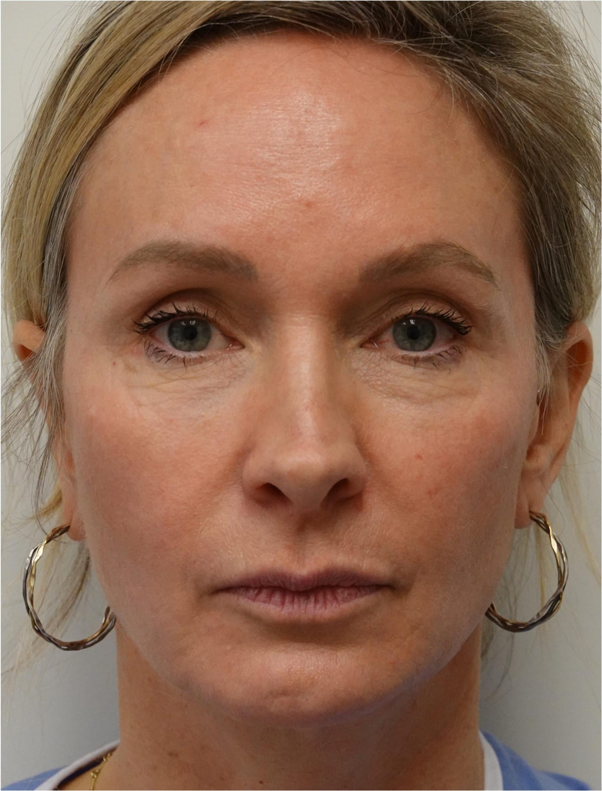 Jason Clain, MD eyelid lift after — Harrison, NY