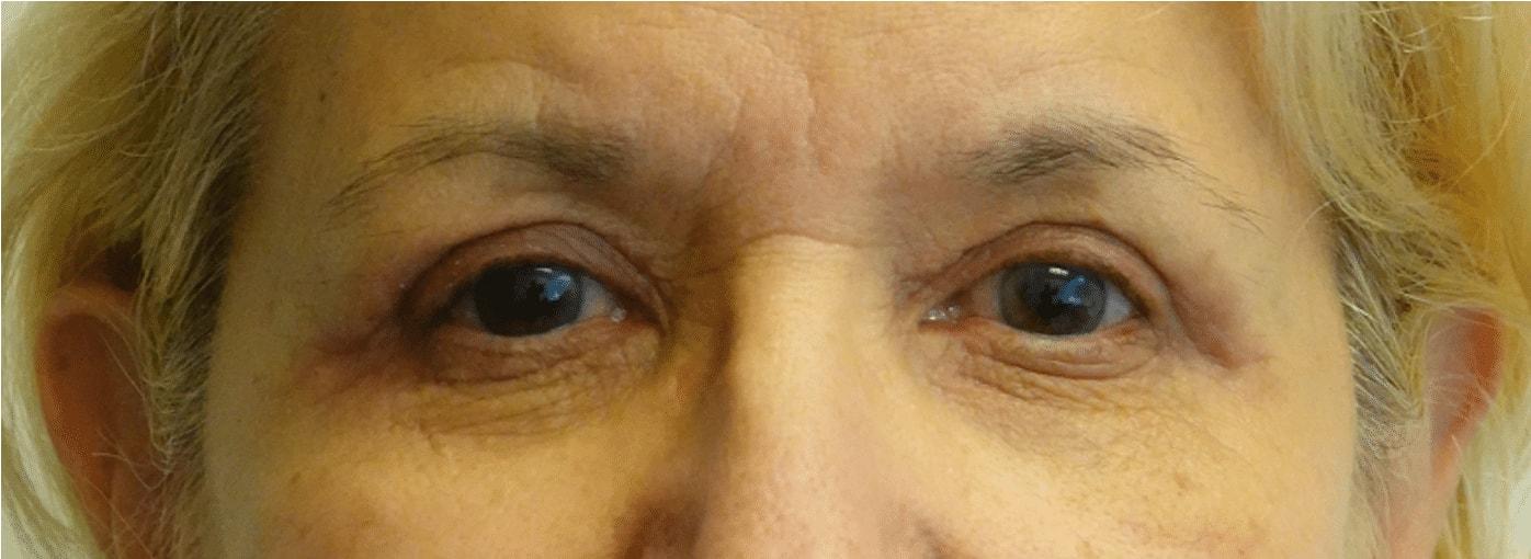 Jason Clain, MD eyelid lift after — Harrison, NY