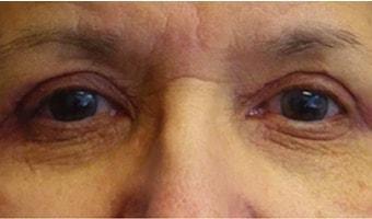 Jason Clain, MD eyelid lift after — Harrison, NY