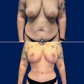 Mommy Makeover result at Capraro Plastic Surgery in Denver, CO