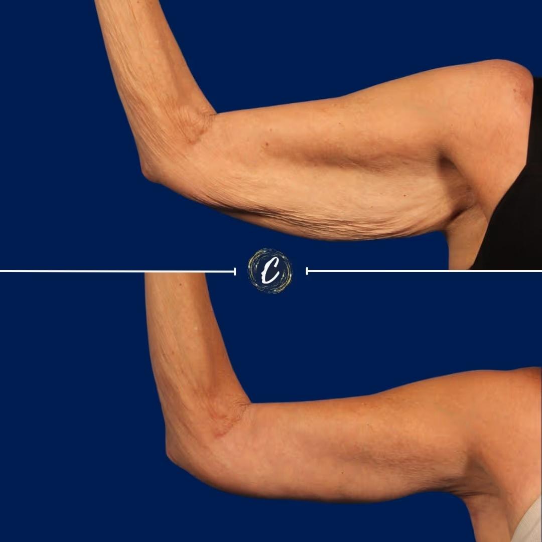 Capraro Plastic Surgery arm lift result — Denver, CO
