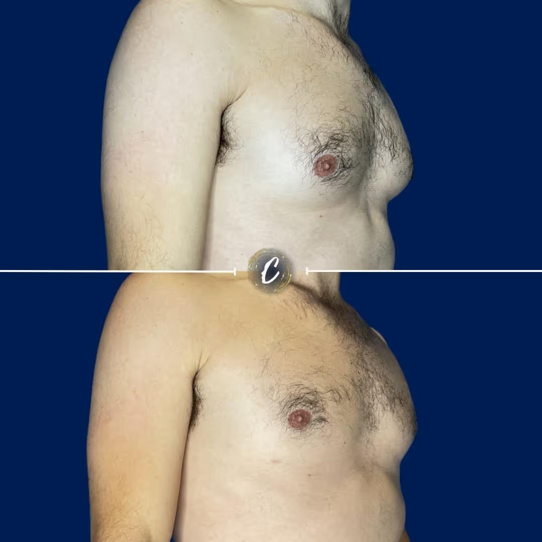Capraro Plastic Surgery gynecomastia result — Denver, CO