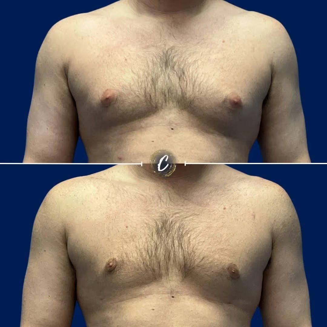 Capraro Plastic Surgery gynecomastia result — Denver, CO