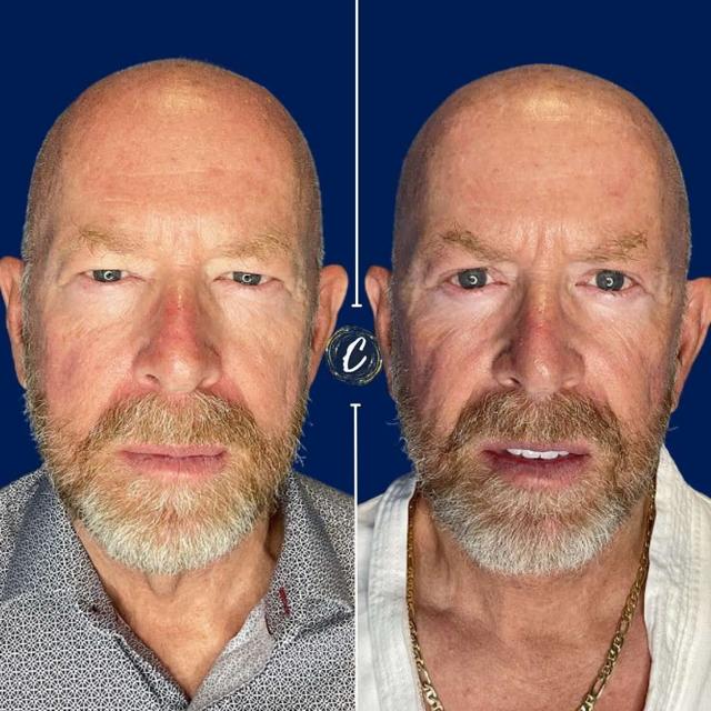 Neck Lift result at Capraro Plastic Surgery in Denver, CO