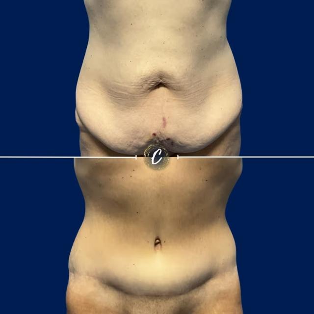 Tummy Tuck result at Capraro Plastic Surgery in Denver, CO