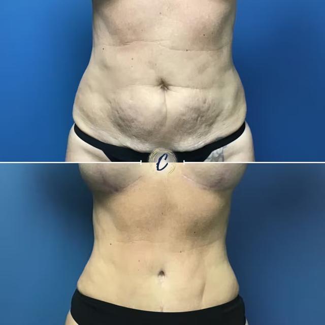Tummy Tuck result at Capraro Plastic Surgery in Denver, CO