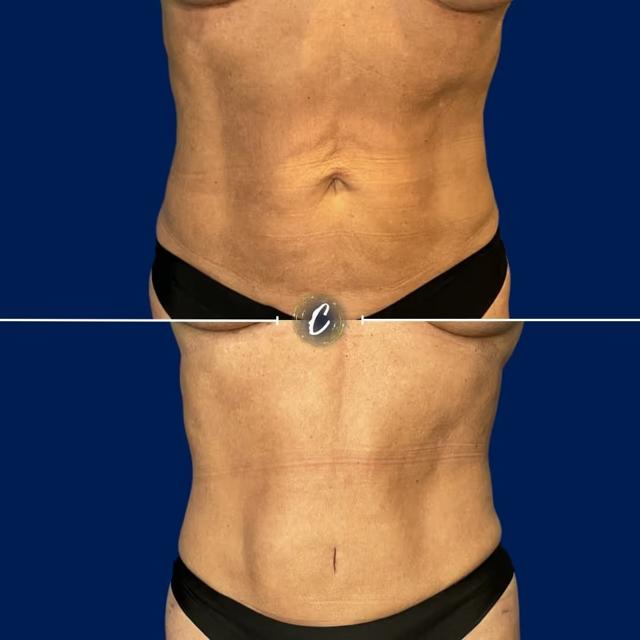 Tummy Tuck result at Capraro Plastic Surgery in Denver, CO